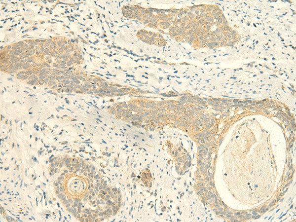 Immunohistochemistry of paraffin-embedded Human esophagus cancer tissue  using MPV17 Polyclonal Antibody at dilution of 1:50(?200)