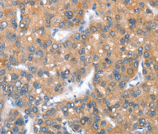 Immunohistochemistry of paraffin-embedded Human liver cancer tissue using CD238 Polyclonal Antibody at dilution 1:40