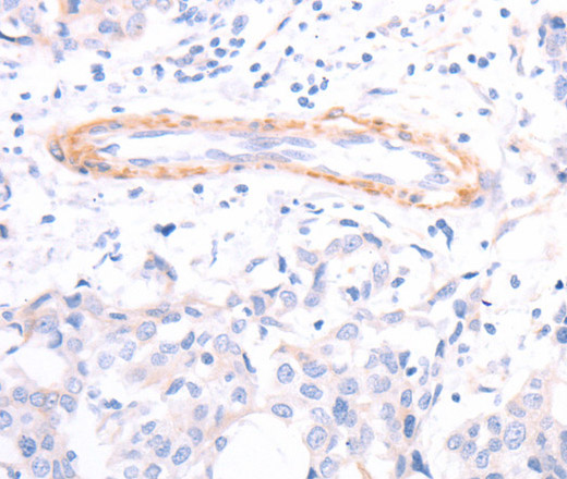 Immunohistochemistry of paraffin-embedded Human breast cancer using TPM1 Polyclonal Antibody at dilution of 1:40