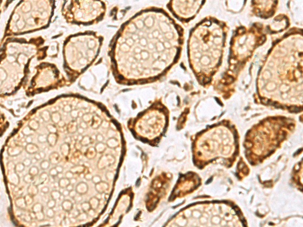 Immunohistochemistry of paraffin-embedded Human thyroid cancer tissue  using LRRC2 Polyclonal Antibody at dilution of 1:55(?200)