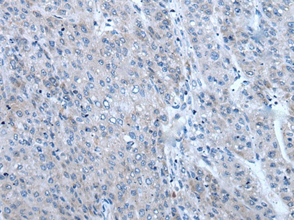 Immunohistochemistry of paraffin-embedded Human liver cancer tissue  using ZIC1 Polyclonal Antibody at dilution of 1:65(?200)