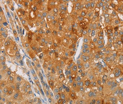 Immunohistochemistry of paraffin-embedded Human liver cancer tissue using ARSG Polyclonal Antibody at dilution 1:30