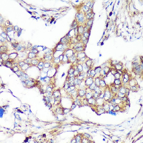 Immunohistochemistry of paraffin-embedded Human colon carcinoma using CAND2 Polyclonal Antibody at dilution of 1:100 (40x lens).Perform microwave antigen retrieval with 10 mM PBS buffer pH 7.2 before commencing with IHC staining protocol.