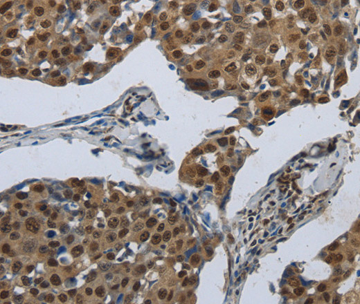 Immunohistochemistry of paraffin-embedded Human breast cancer using PRKAR1B Polyclonal Antibody at dilution of 1:70