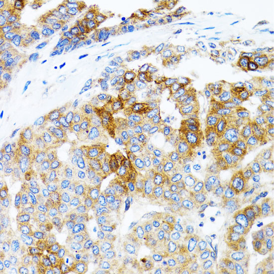 Immunohistochemistry of paraffin-embedded Human liver cancer using STAT3 Polyclonal Antibody at dilution of 1:100 (40x lens).