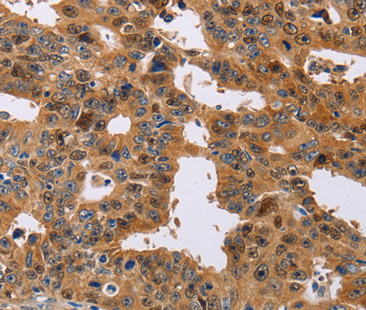 Immunohistochemistry of paraffin-embedded Human gasrtic cancer tissue using NIF3L1 Polyclonal Antibody at dilution 1:30