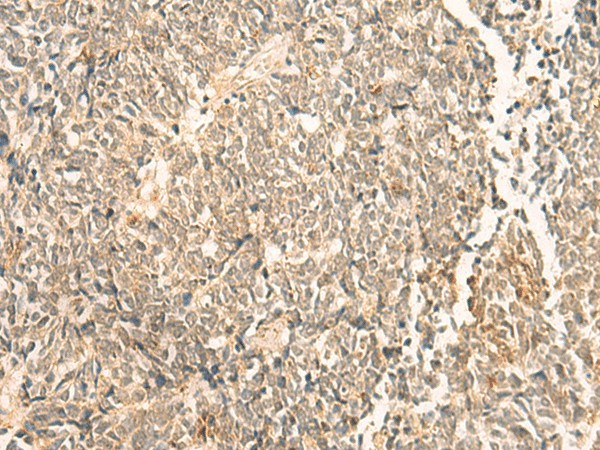 Immunohistochemistry of paraffin-embedded Human lung cancer tissue  using NIP7 Polyclonal Antibody at dilution of 1:50(?200)