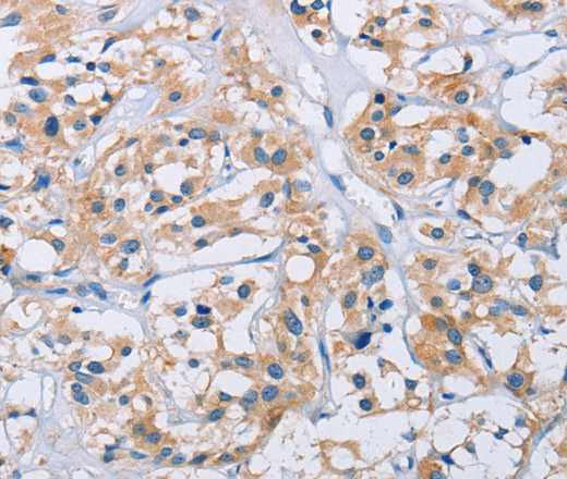 Immunohistochemistry of paraffin-embedded Human thyroid cancer tissue using CCR9 Polyclonal Antibody at dilution 1:60