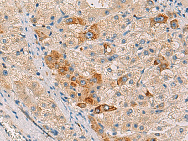 Immunohistochemistry of paraffin-embedded Human liver cancer tissue  using RMDN2 Polyclonal Antibody at dilution of 1:50(?200)