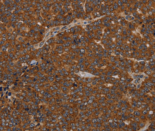 Immunohistochemistry of paraffin-embedded Human ovarian cancer using GDF2 Polyclonal Antibody at dilution of 1:40