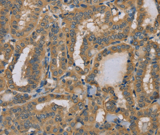 Immunohistochemistry of paraffin-embedded Human thyroid cancer using MYL3 Polyclonal Antibody at dilution of 1:40