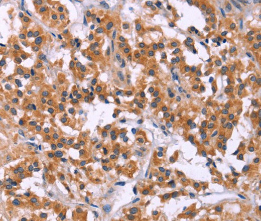 Immunohistochemistry of paraffin-embedded Human thyroid cancer tissue using MSMO1 Polyclonal Antibody at dilution 1:40