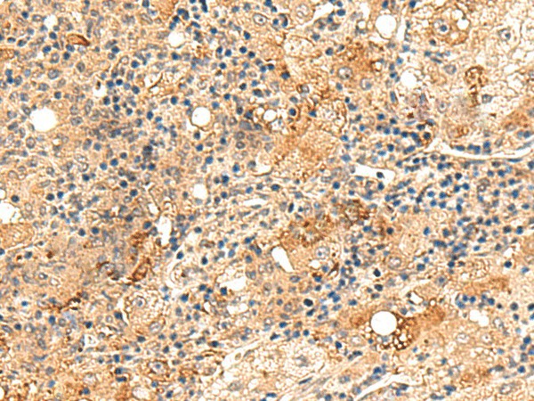 Immunohistochemistry of paraffin-embedded Human liver cancer tissue  using REG1B Polyclonal Antibody at dilution of 1:60(?200)