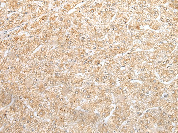 Immunohistochemistry of paraffin-embedded Human liver cancer tissue  using NUDT19 Polyclonal Antibody at dilution of 1:25(?200)