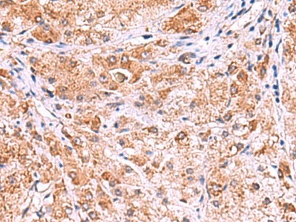 Immunohistochemistry of paraffin-embedded Human liver cancer tissue  using UXS1 Polyclonal Antibody at dilution of 1:60(?200)