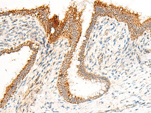 Immunohistochemistry of paraffin-embedded Human cervical cancer tissue  using GRIK5 Polyclonal Antibody at dilution of 1:35(?200)