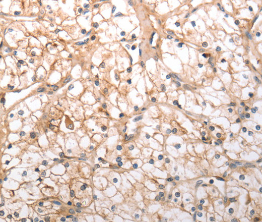 Immunohistochemistry of paraffin-embedded Human renal cancer tissue using HCRTR1 Polyclonal Antibody at dilution 1:100