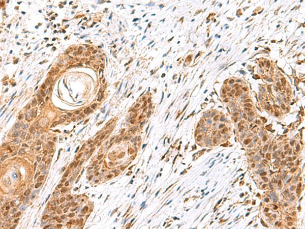 Immunohistochemistry of paraffin-embedded Human esophagus cancer tissue  using MECR Polyclonal Antibody at dilution of 1:60(?200)