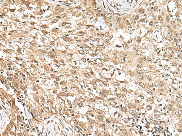 Immunohistochemistry of paraffin-embedded Human esophagus cancer tissue  using RPS6KA5 Polyclonal Antibody at dilution of 1:160(?200)