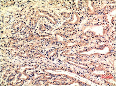 Immunohistochemistry of paraffin-embedded Human stomach carcinoma tissue using CHOP Monoclonal Antibody at dilution of 1:200.