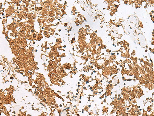 Immunohistochemistry of paraffin-embedded Human lung cancer tissue  using SCRN2 Polyclonal Antibody at dilution of 1:60(?200)