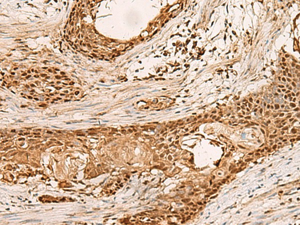 Immunohistochemistry of paraffin-embedded Human esophagus cancer tissue  using PAFAH1B2 Polyclonal Antibody at dilution of 1:50(?200)