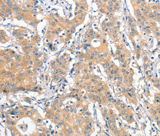 Immunohistochemistry of paraffin-embedded Human gastric cancer tissue using ANKMY2 Polyclonal Antibody at dilution 1:30