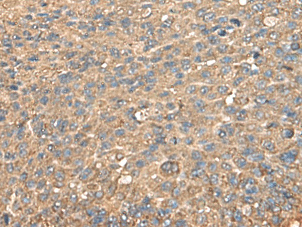 Immunohistochemistry of paraffin-embedded Human liver cancer tissue  using RPS14 Polyclonal Antibody at dilution of 1:60(?200)