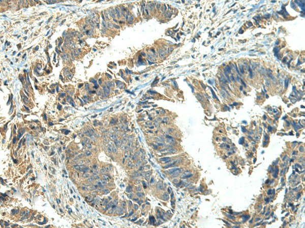 Immunohistochemistry of paraffin-embedded Human colorectal cancer tissue  using NPVF Polyclonal Antibody at dilution of 1:65(?200)