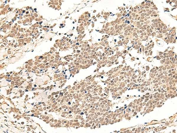 Immunohistochemistry of paraffin-embedded Human lung cancer tissue  using GPR139 Polyclonal Antibody at dilution of 1:50(?200)