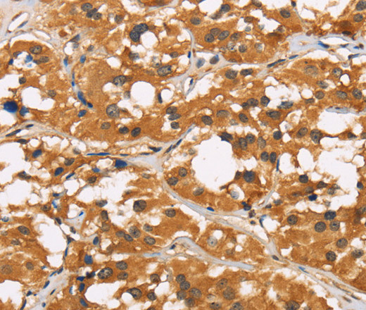 Immunohistochemistry of paraffin-embedded Human thyroid cancer tissue using CD22 Polyclonal Antibody at dilution 1:50