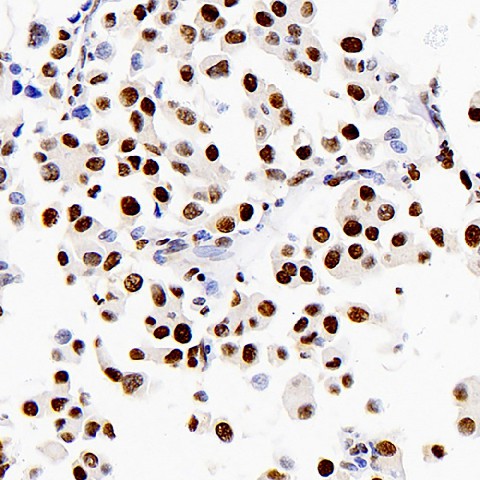 Immunohistochemistry analysis of paraffin-embedded human lung cancer  using Proliferating Cell Nuclear Antigen Polyclonal Antibody at dilution of 1:1000.