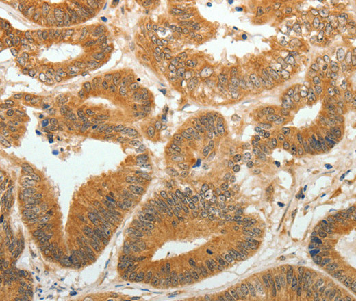 Immunohistochemistry of paraffin-embedded Human colon cancer using AKR1C1 Polyclonal Antibody at dilution of 1:30