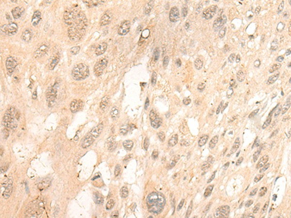 Immunohistochemistry of paraffin-embedded Human esophagus cancer tissue  using CUTA Polyclonal Antibody at dilution of 1:45(?200)