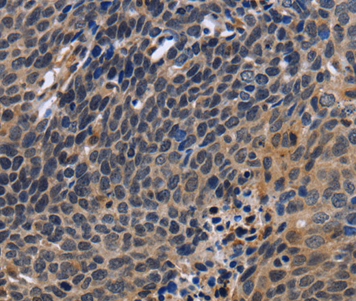 Immunohistochemistry of paraffin-embedded Human cervical cancer tissue using FSTL1 Polyclonal Antibody at dilution 1:30