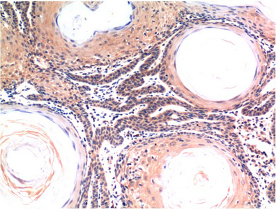 Immunohistochemistry of paraffin-embedded Human skin tissue using CASP3 Monoclonal Antibody at dilution of 1:200.