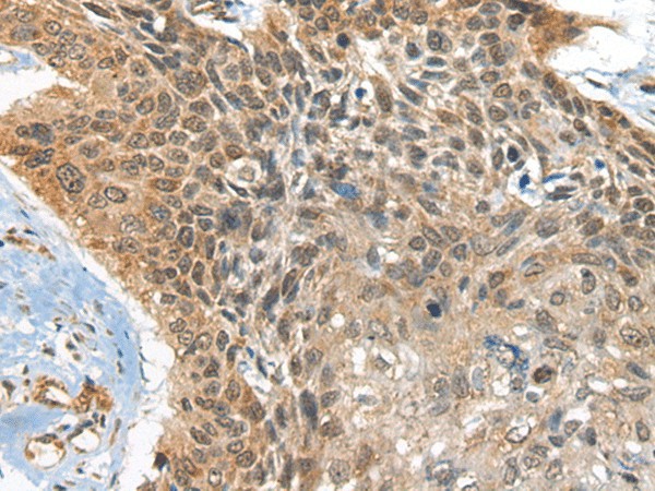 Immunohistochemistry of paraffin-embedded Human esophagus cancer tissue  using BOLA1 Polyclonal Antibody at dilution of 1:35(?200)