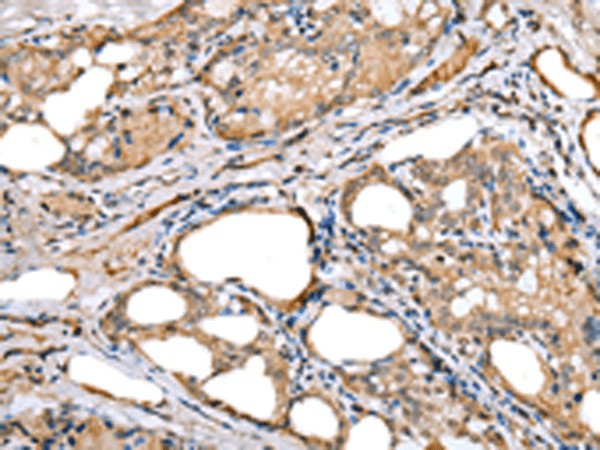 Immunohistochemistry of paraffin-embedded Human thyroid cancer tissue  using LRRC19 Polyclonal Antibody at dilution of 1:30(?200)