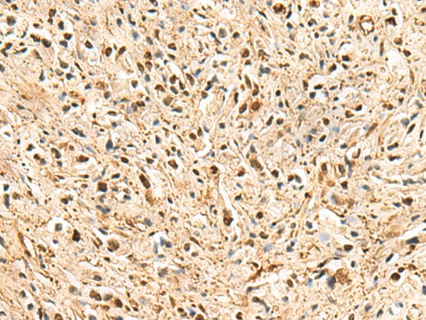 Immunohistochemistry of paraffin-embedded Human prost ate cancer tissue  using PSMA3 Polyclonal Antibody at dilution of 1:50(?200)