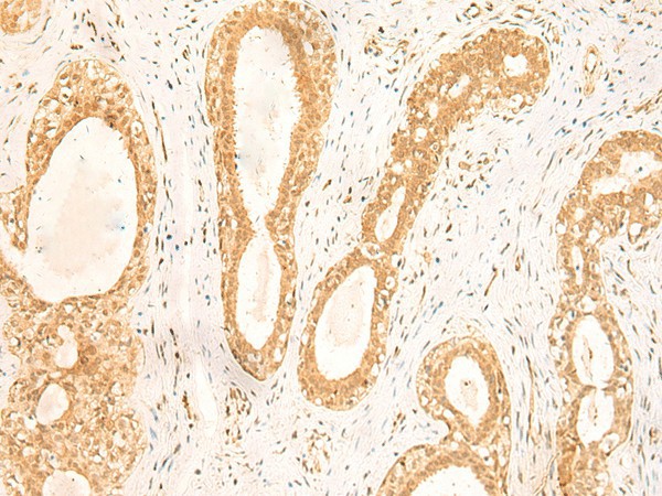 Immunohistochemistry of paraffin-embedded Human breast cancer tissue  using ST8SIA4 Polyclonal Antibody at dilution of 1:50(?200)