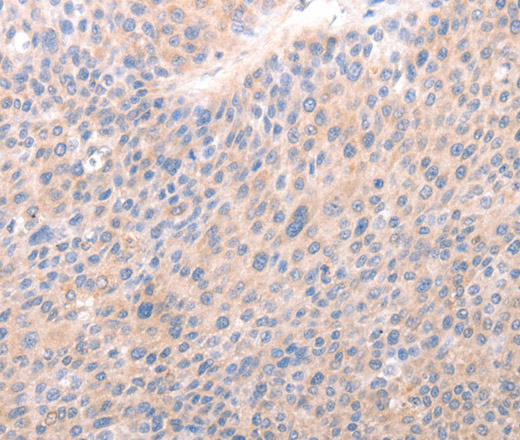 Immunohistochemistry of paraffin-embedded Human liver cancer tissue using ACO1 Polyclonal Antibody at dilution 1:50