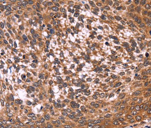 Immunohistochemistry of paraffin-embedded Human cervical cancer tissue using CCDC106 Polyclonal Antibody at dilution 1:50