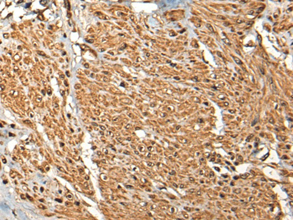 Immunohistochemistry of paraffin-embedded Human prost ate cancer tissue  using MICU1 Polyclonal Antibody at dilution of 1:35(?200)