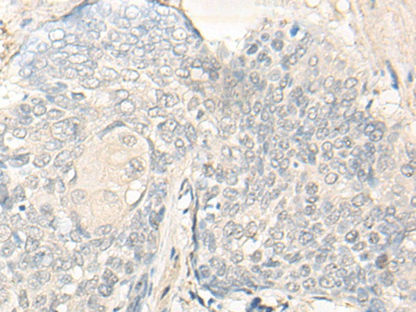 Immunohistochemistry of paraffin-embedded Human esophagus cancer tissue  using DIMT1 Polyclonal Antibody at dilution of 1:30(?200)