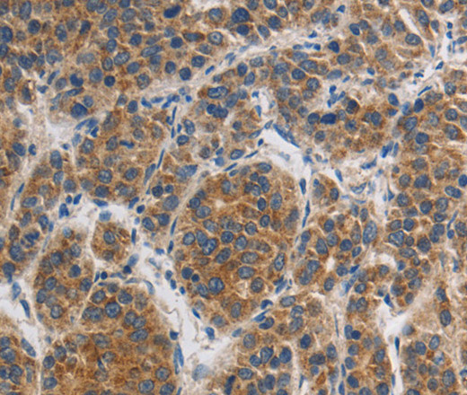 Immunohistochemistry of paraffin-embedded Human liver cancer tissue using GRIN1 Polyclonal Antibody at dilution 1:45