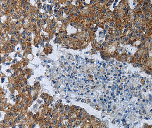 Immunohistochemistry of paraffin-embedded Human breast cancer tissue using EIF2AK2 Polyclonal Antibody at dilution 1:60