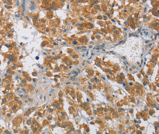 Immunohistochemistry of paraffin-embedded Human thyroid cancer tissue using DIO1 Polyclonal Antibody at dilution 1:60