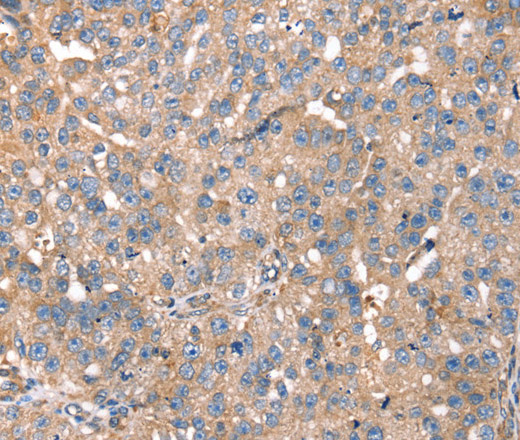 Immunohistochemistry of paraffin-embedded Human breast cancer using PDLIM4 Polyclonal Antibody at dilution of 1:40