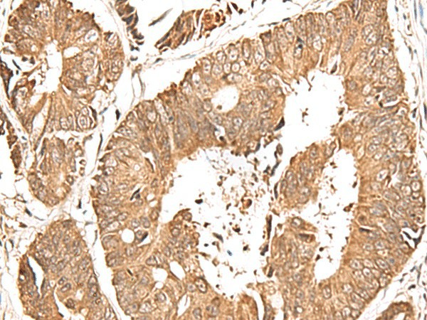 Immunohistochemistry of paraffin-embedded Human colorectal cancer tissue  using GFI1 Polyclonal Antibody at dilution of 1:60(?200)