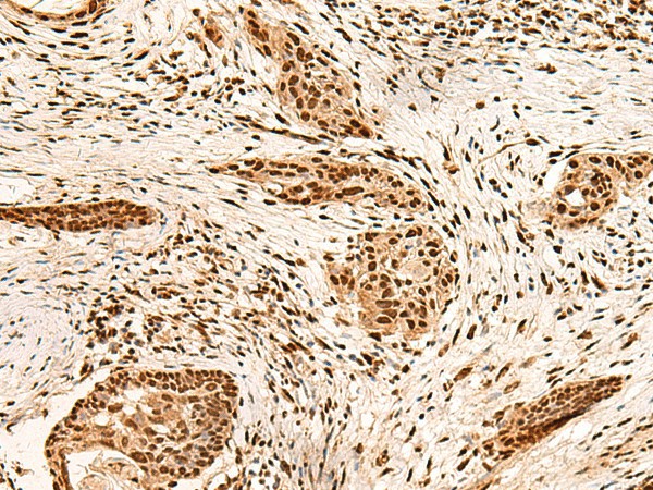 Immunohistochemistry of paraffin-embedded Human esophagus cancer tissue  using PAFAH1B2 Polyclonal Antibody at dilution of 1:60(?200)